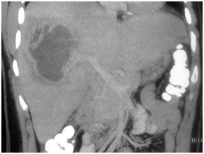 Amoebic Liver Abscess
