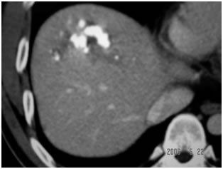 CT Scan showing Lipoidol uptake in segment VIII