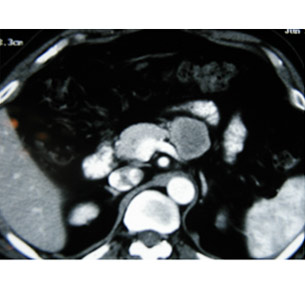 CT scan of pancreatic cancer in the body
