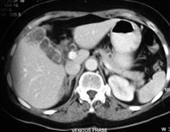 CT Scan Showing Cancer Gall Bladder