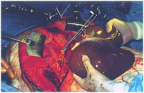 Deceased Donor Liver transplant