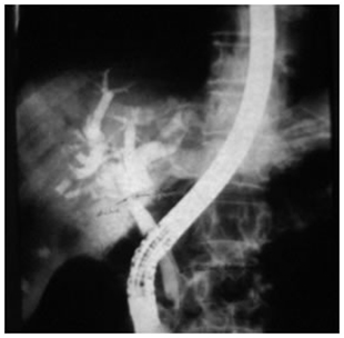 ERCP showing type I hilar block
