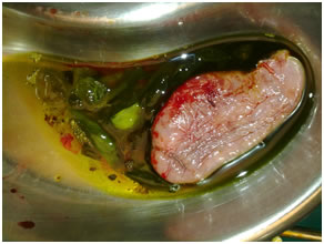 Gallbladder containing daughter cyst