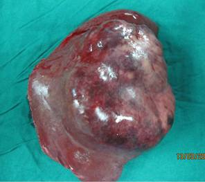HCC in a non cirrhotic liver