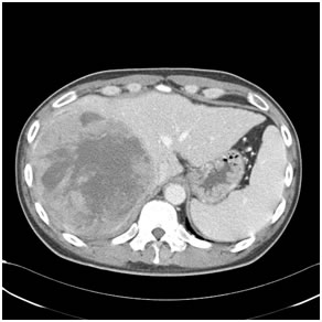 Hepatobiliary Disorders Requiring Surgery