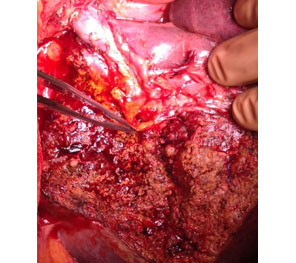 Hilar CC after resection