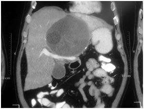Hydatic Cyst in Liver