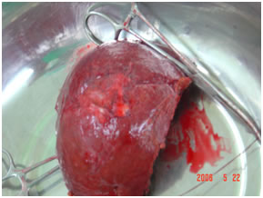 Specimen Showing Desected Gallbladder cancer