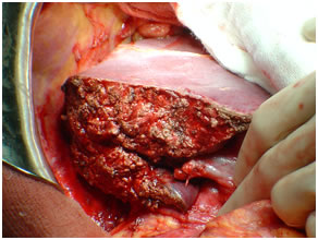 Removal of Cancer Gallbladder