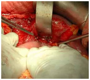 Intra Operative picture of Hepatico Jejunostomy
