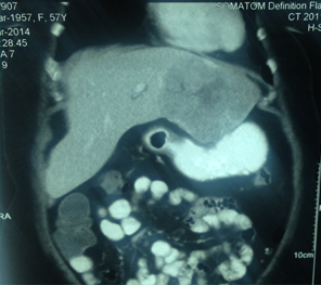Large HCC in seg 2&3