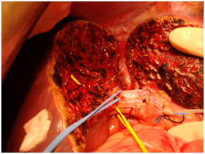 Living Donor Hepatectomy