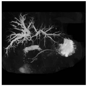 MRCP showing type III b hilar tumor