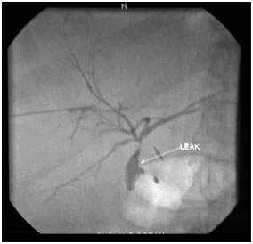 PTBD gram showing biliiary leak
