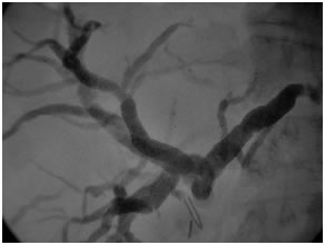 PTBD gram showing type II biliary stricture