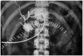 Post operative PTBD gram showing a patent high hepaticojejunostomy