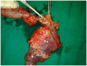 Resected specimen after
Whipple's procedure