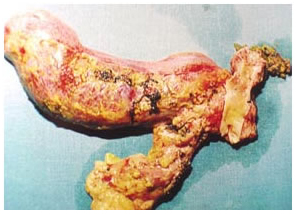 Specimen of radical bile duct excision