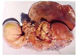Specimen of resected hilarcholangiocarcinoma