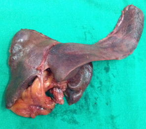 Type 3b resected specimen