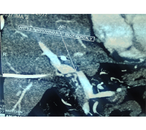 Vascular narrowing of R PV in type 3b