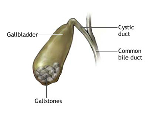 Gall Bladder Stone Disease